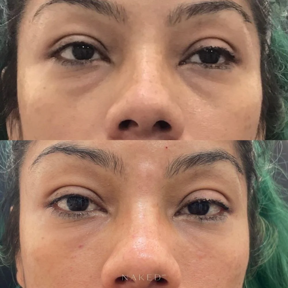 Undereye Filler - Image 6